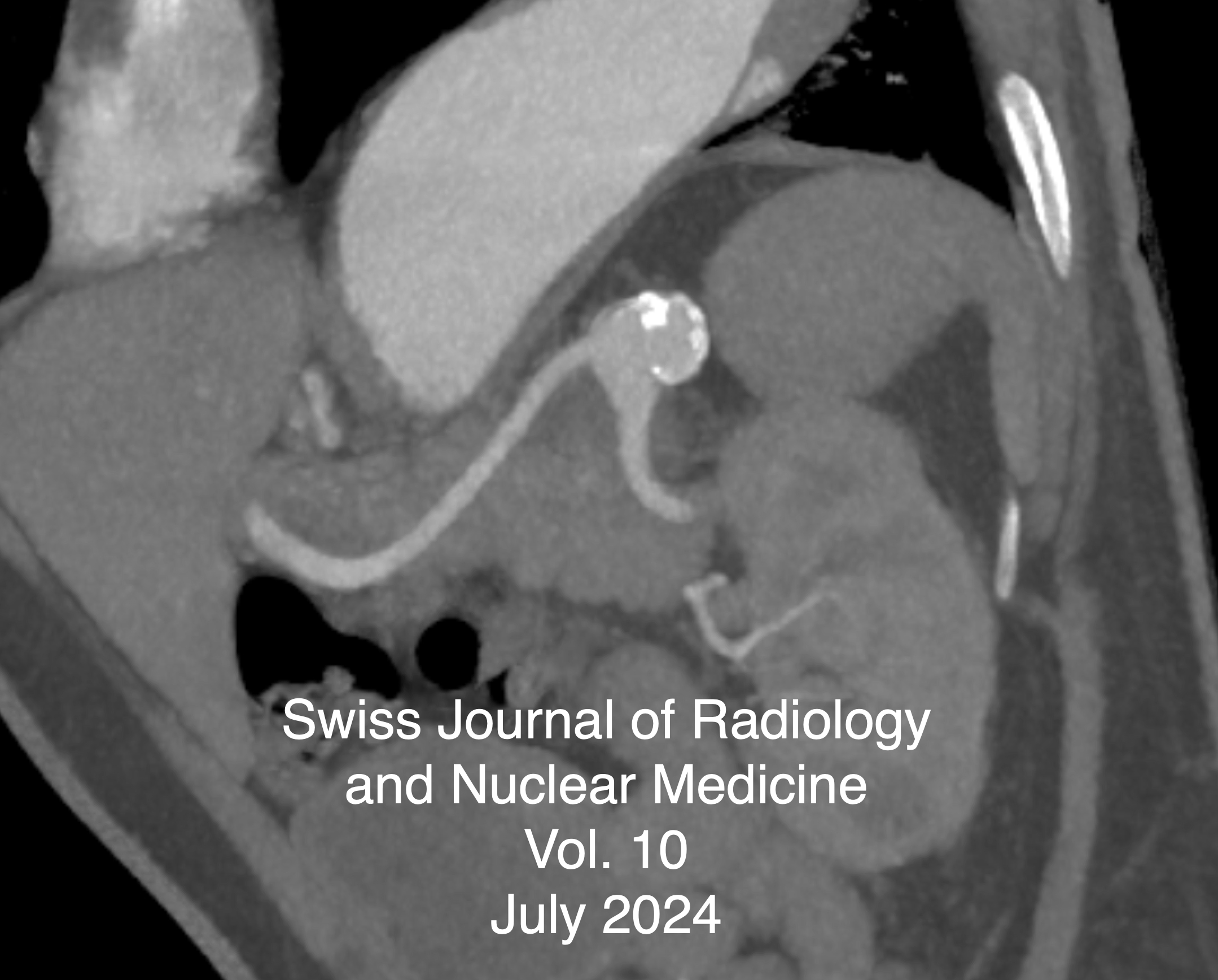 					View Vol. 10 No. 1 (2024): Splenic Artery Aneurysm Occlusion & Nasopharyngeal Metastasis of Papillary Thyroid Carcinoma & Study of Multimodality Imaging Features of Brown Tumor or Osteitis Fibrosa Cystica
				