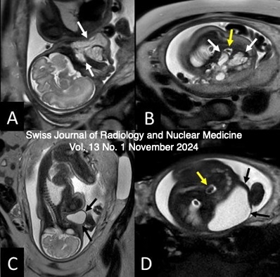 Swiss Journal of Radiology and Nuclear Medicine, Vol.13 No. 1, November 2024