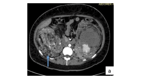 cover_article_Vol_27_SJORANM_January_2026_Tuberous_Sclerosis_Complex_sjoranm.v27i1.20_Veerappan_India
