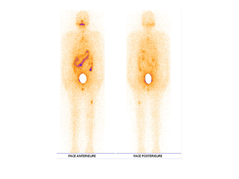 cover_image_article_Management_Bone_Metastasis_Thyroid_Carcinoma_sjoranm.v27i1.24_Batani_Morocco