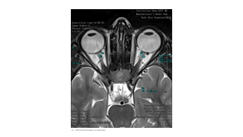cover_article_MRI-Based_Optic_Nerve_Sheath_Diameter_Measurements