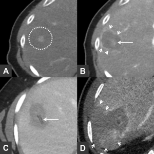 Ablation zones