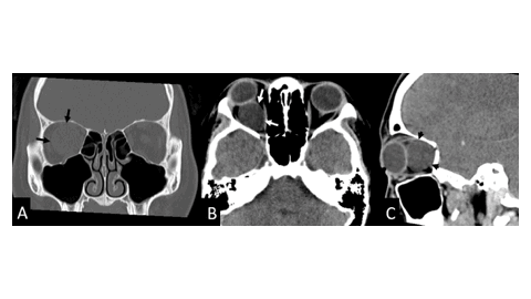 article_cover_image_optic_nerve_sheath