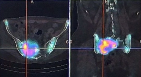 SPECT-CT of pelvis