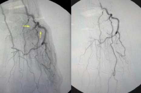 Trans-Arterial Embolization for Osteoarthritis