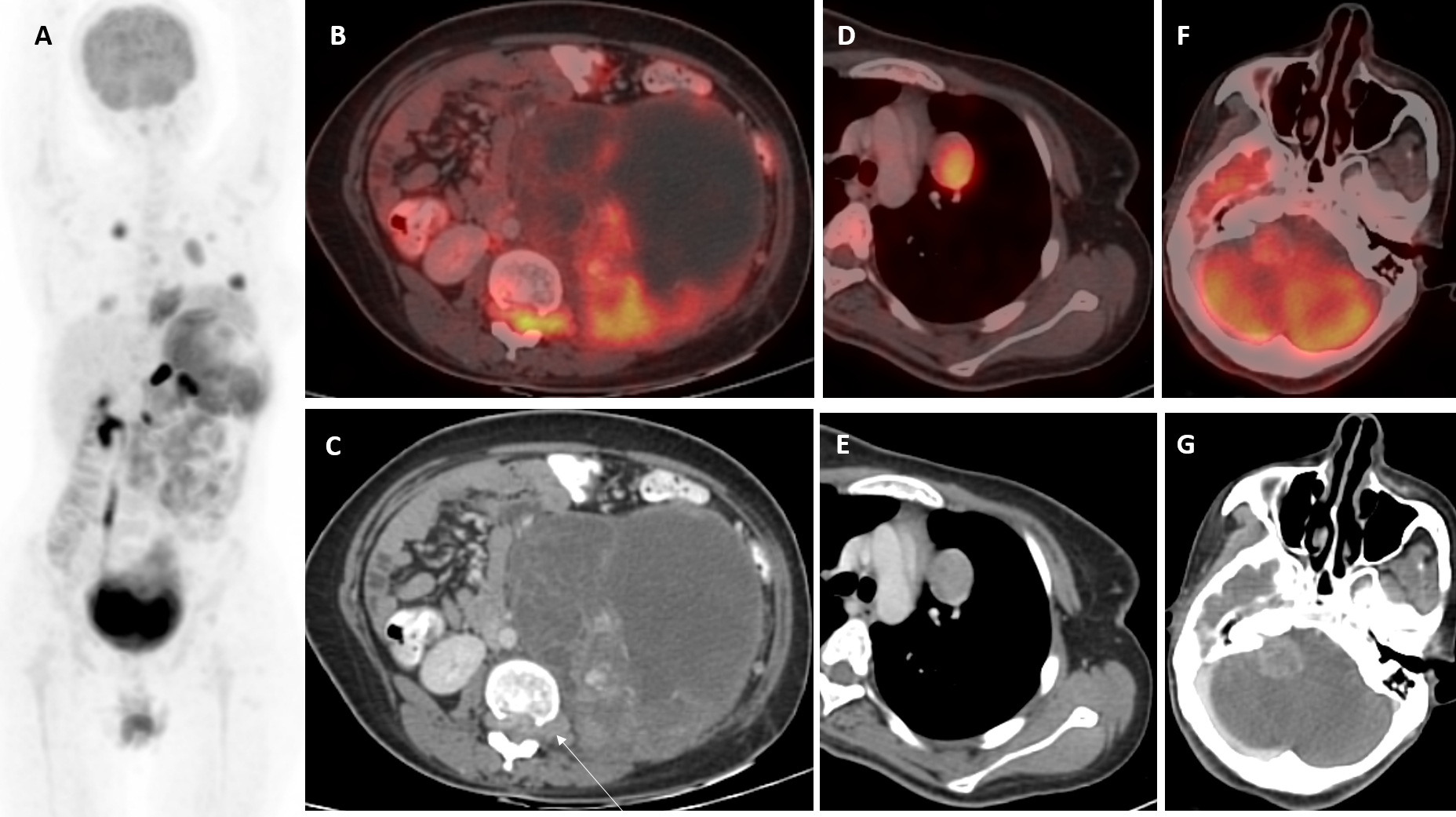 Sjoranm_Vol_15_Vol.1_Metastatic Malignant Peripheral Nerve Sheath Tumor with Its Imaging Features_Ritesh_Suthar_January_2025