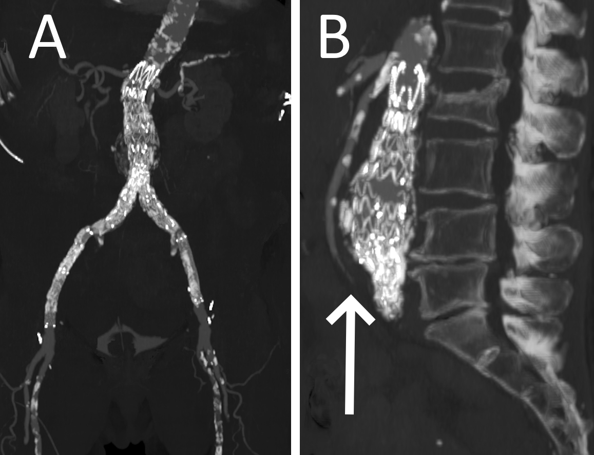 The Silent Danger: A Rare Case of Asymptomatic Aortocaval Fistula Discovered During Routine Imaging