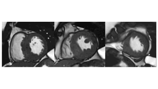 Figures of strain analysis with cardiac MRI