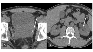 Prostate Sarcoma