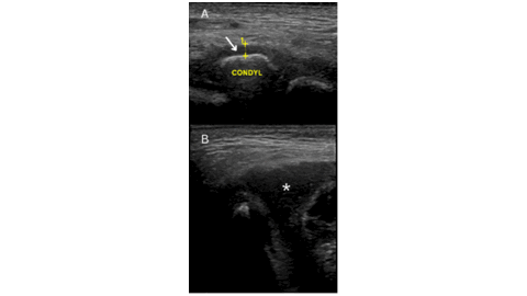Cover_image_Septic_arthritis_of_the_temporomandibular_joint_in_a_6-year-old_boy
