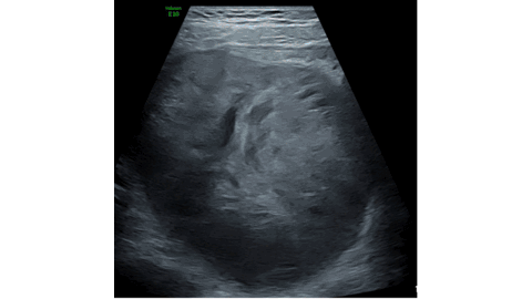 A Malignant Yolk Sac Tumor of the Ovary Presenting as Adnexal Torsion in a Child
