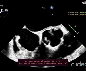 Cryptic_septic_endocarditis_and_systemic_thromboembolism_triggered_by_oral_microflora