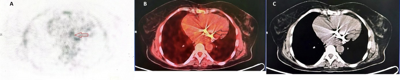 article_jpg_infective_endocarditis